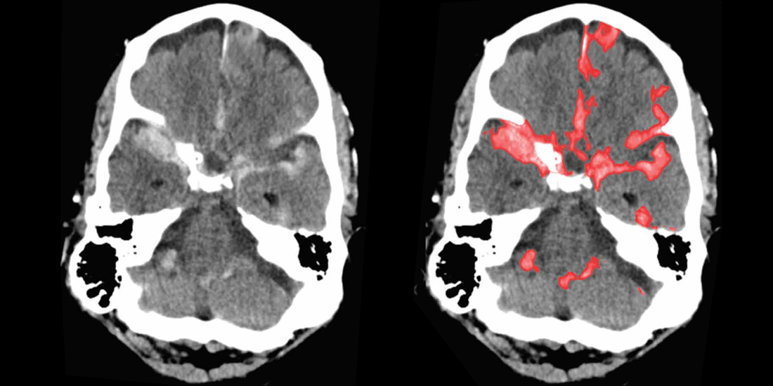 Two brain scans: One as normally seen by a radiologist, and one with hemorrhaging areas highlighted by AI technology