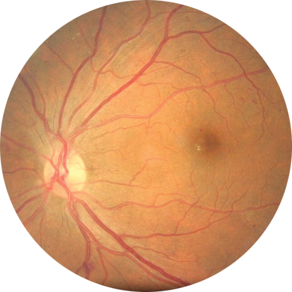 Image from retinal scan