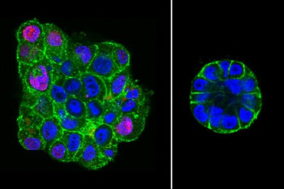 Fluorescence images of uncompressed (left) and compressed (right) colonies of malignant breast epithelial cells. Compressed colonies are smaller and more organized. (Images courtesy of Fletcher Lab)