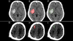 Brain with hemorrhages highlightedscans