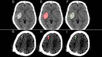 Brain with hemorrhages highlightedscans