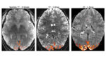 A comparison of human brain scans using the NexGen 7T MRI at higher resolution (left) vs a standard 7T scanner (middle) and the standard 3T hospital scanner (right). With higher resolution, neuroscientists can more precisely localize signals (orange) in the brain to understand normal brain circuitry and the changes associated with brain disorders.