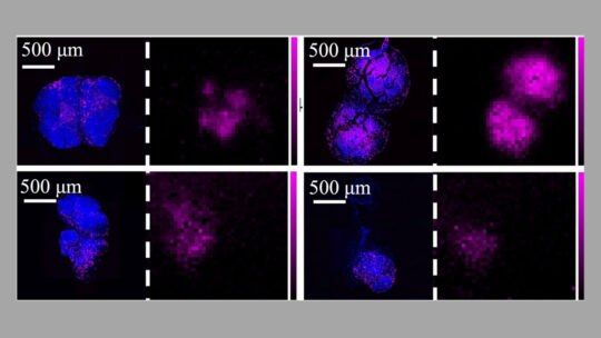 Traditionally, fluorescence microscopes (blue images) are used to image tumors. A new image sensor (purple images) could do the same, less invasively.